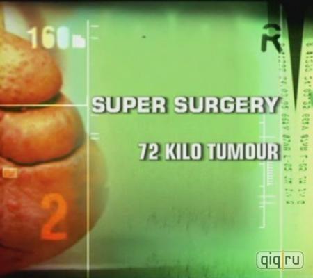 Discovery: Радикальная хирургия. Опухоль весом 72 килограмма / Super Surgery. 72 Kilo Tumour () смотреть онлайн бесплатно в отличном качестве