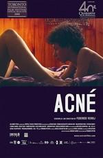 Угри / Acné (2008) смотреть онлайн бесплатно в отличном качестве